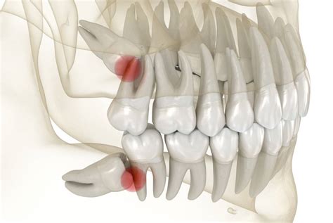 first and second molars|Causes, Treatments, and Tips for Molar Pain .